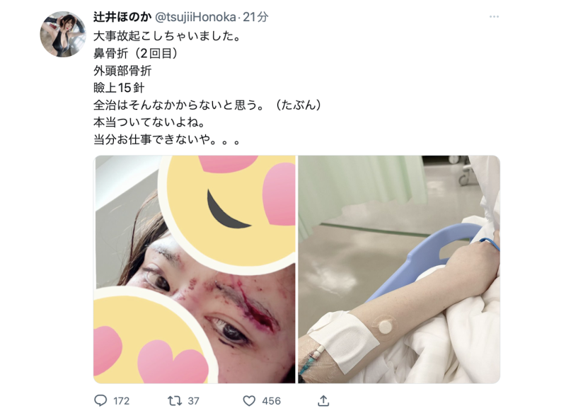 复原力堪比链锯人！辻井ほのか(辻井穗乃果)现在的伤势是⋯ 