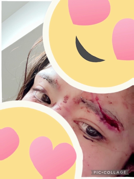 鼻子骨折眼皮缝了15针！辻井ほのか(辻井穗乃果)重伤破相！ 
